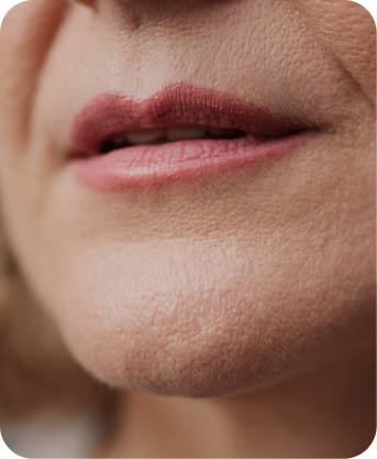 Aumento de labios