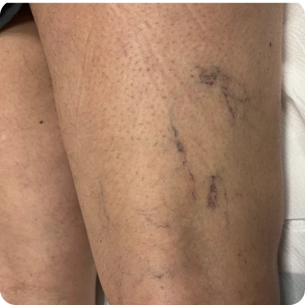 ESCLEROTERAPIA tratamiento las palmas