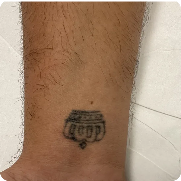 Eliminación de tatuajes tratamiento