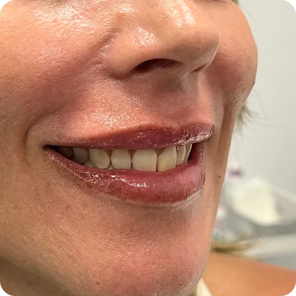 Sonrisa gingival tratamiento clinica estética