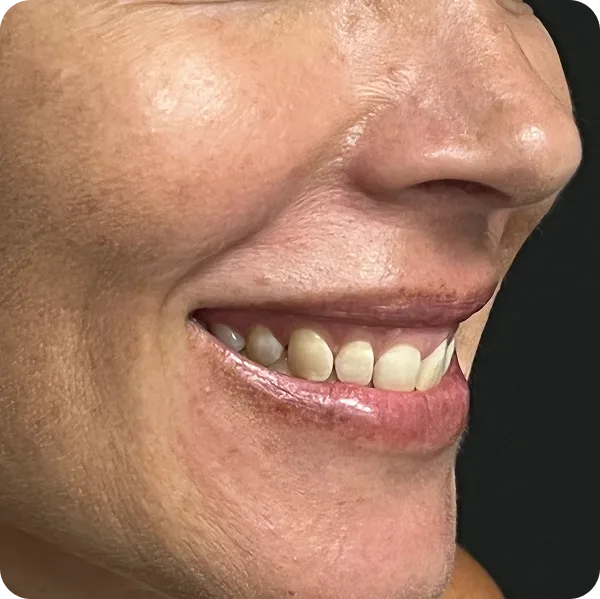 Sonrisa gingival tratamiento las palmas