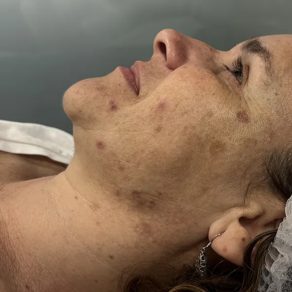 bioestimulación clinica las palmas