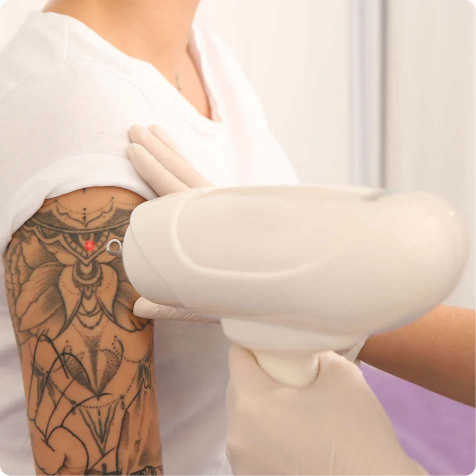 clinica eliminación tatuajes