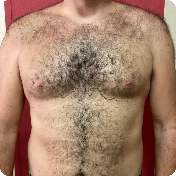 depilación laser hombre