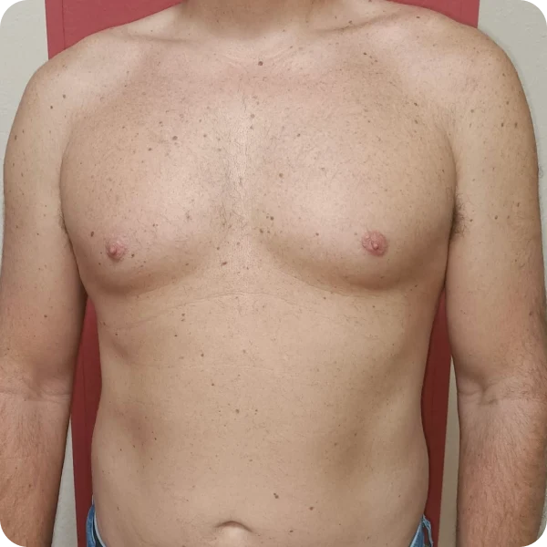 depilación laser mujer