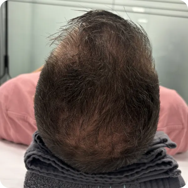 mesoterapia vitaminas hombre las palmas