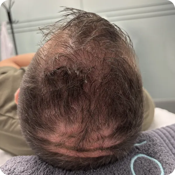 mesoterapia vitaminas hombre