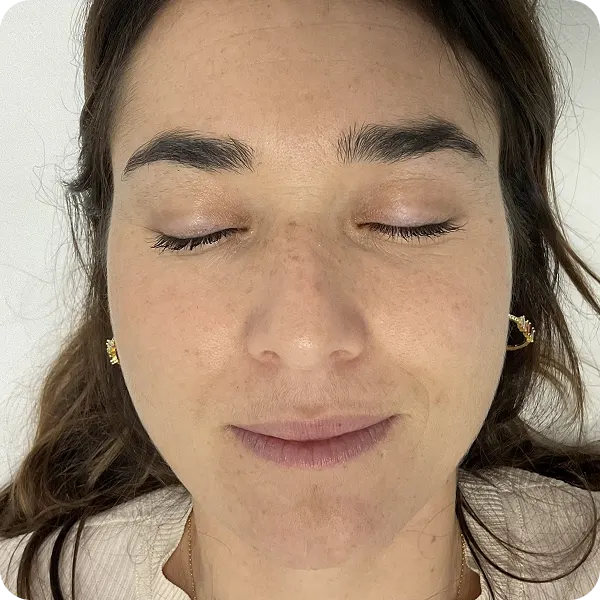 peeling químico clinica estetica