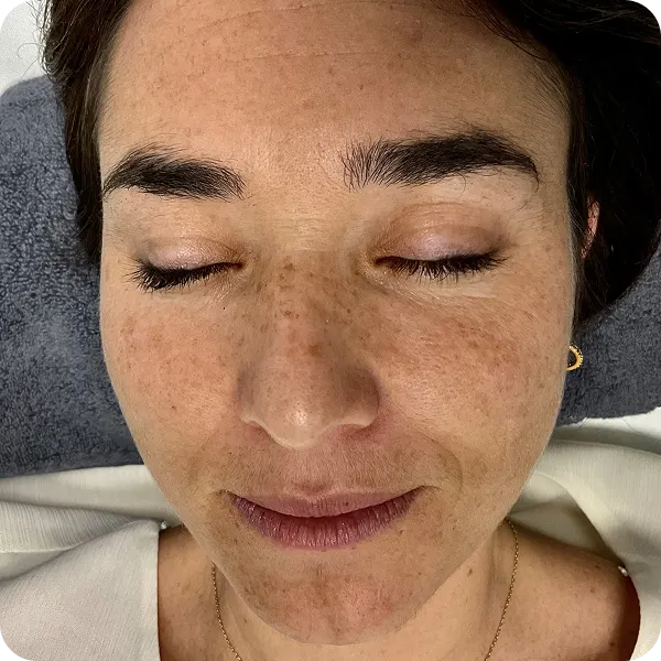 peeling químico clinica tratamiento