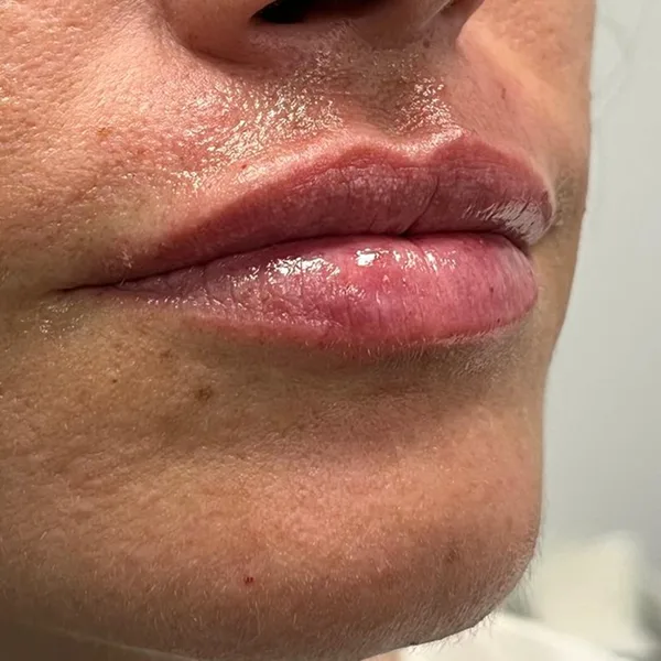 relleno labios clinica las palmas gran canaria