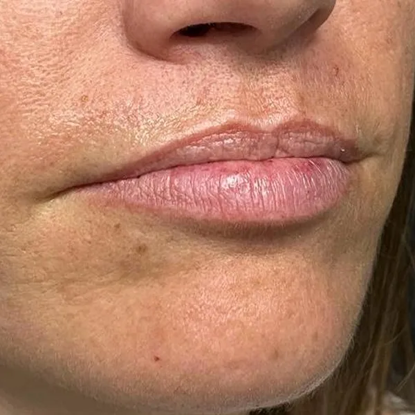 relleno labios clinica las palmas