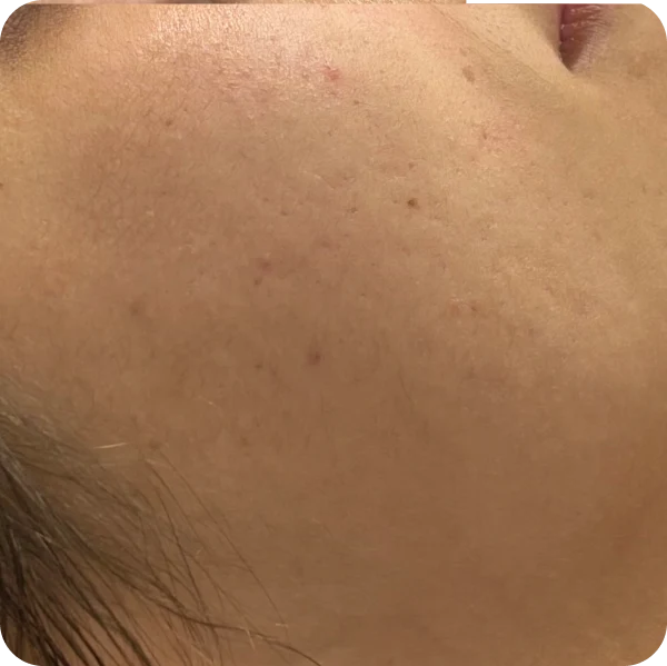tratamiento acne las palmas orobal