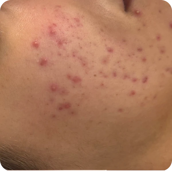tratamiento acne las palmas